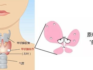 体质与甲状腺结节：揭秘易感体质之谜